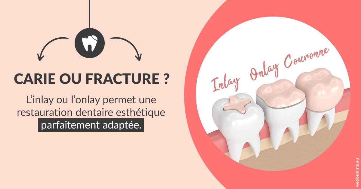 https://dr-baudouin-gilles.chirurgiens-dentistes.fr/T2 2023 - Carie ou fracture 2