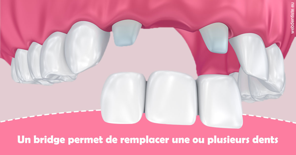 https://dr-baudouin-gilles.chirurgiens-dentistes.fr/Bridge remplacer dents 2