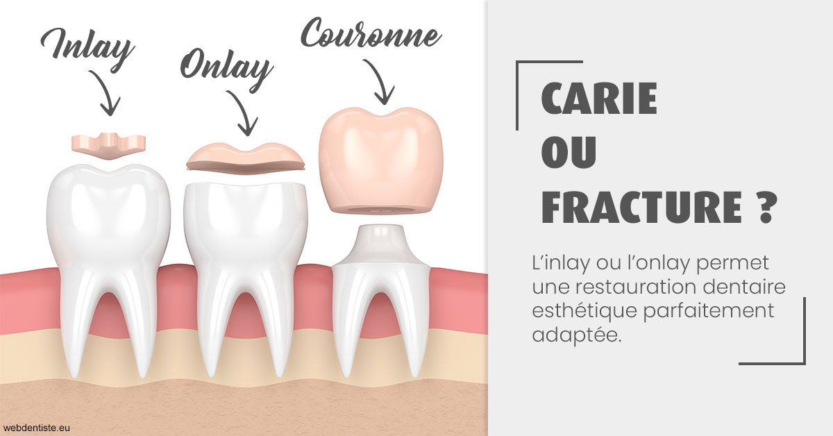 https://dr-baudouin-gilles.chirurgiens-dentistes.fr/T2 2023 - Carie ou fracture 1