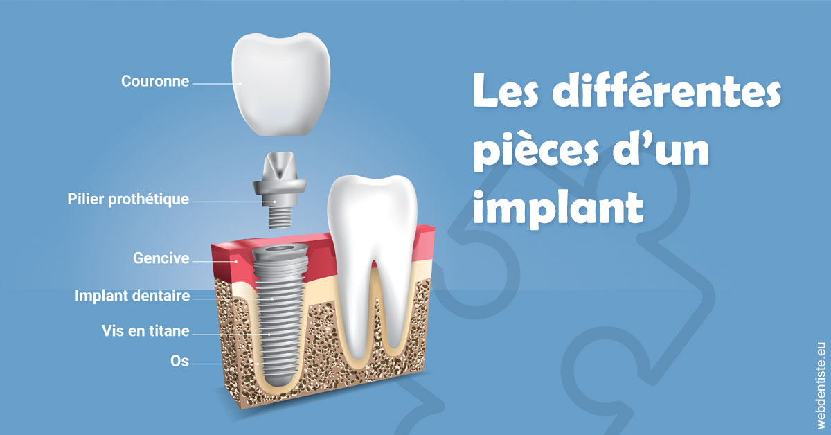 https://dr-baudouin-gilles.chirurgiens-dentistes.fr/Les différentes pièces d’un implant 1